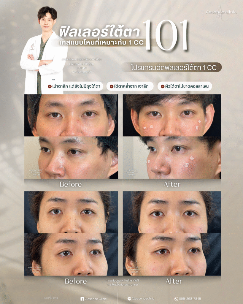 ใต้ตา1cc