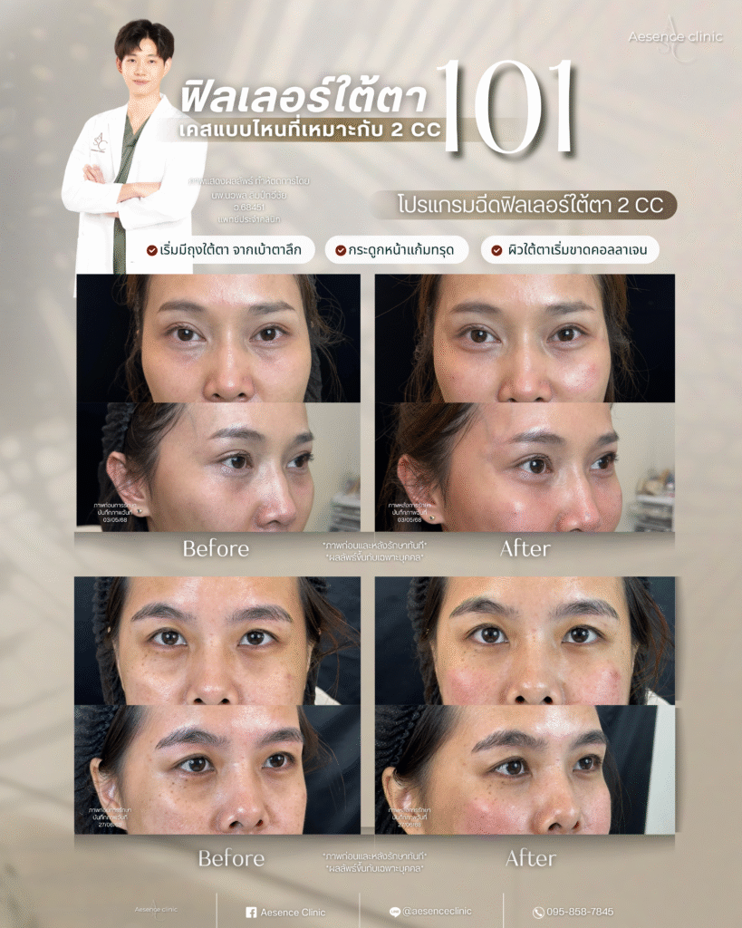 ใต้ตา2cc