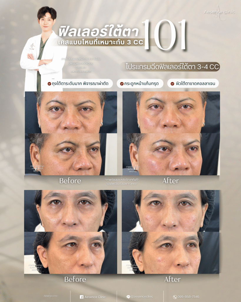 ใต้ตา3cc